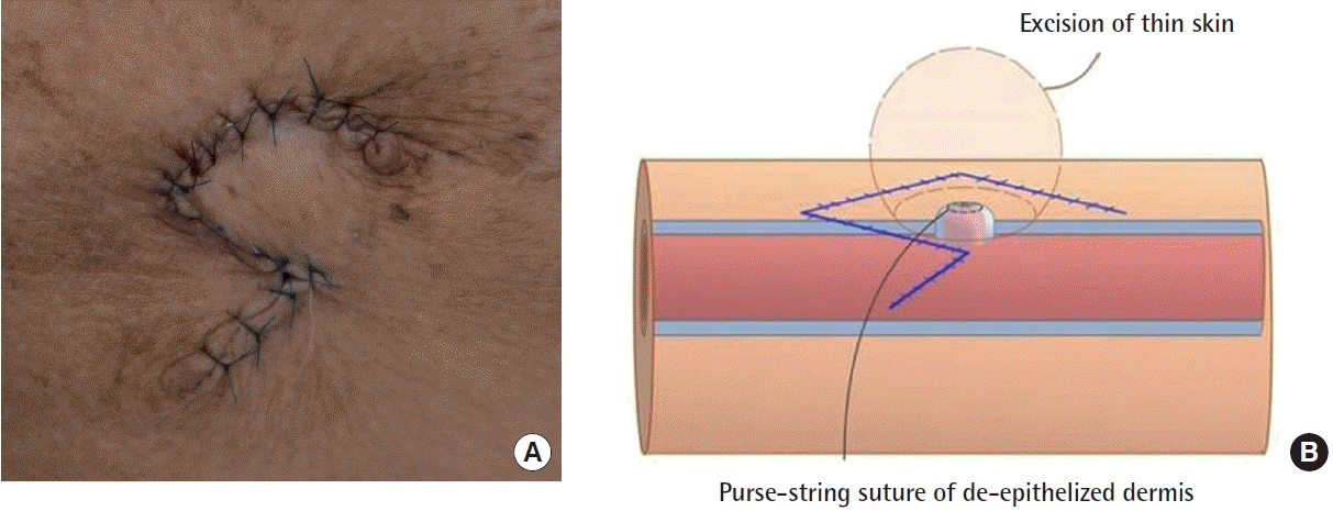 Illustration of the “lead inverting stitch”. A. Purse-s | Open-i