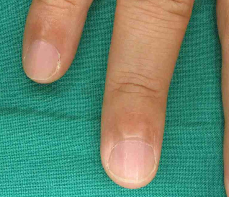 the treatment of glomus finger