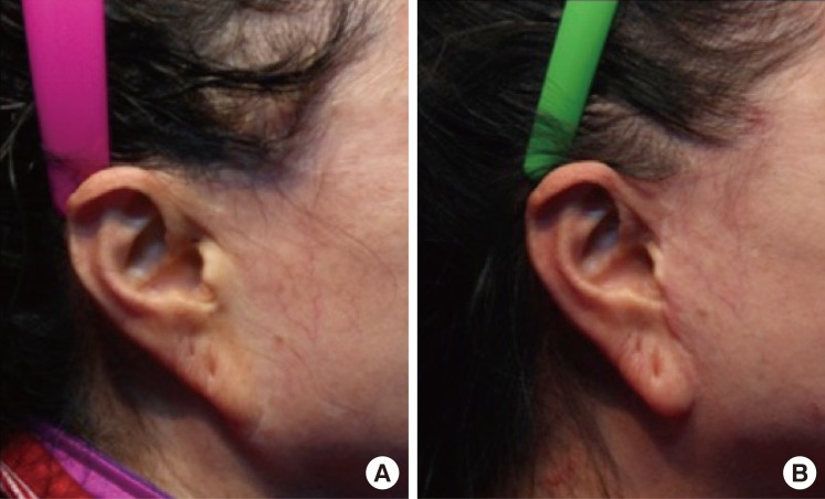 Palmieri's double suture skin repair: a new double suture approach to cases  of skin cancer and ulcerative lesions | World Journal of Surgical Oncology  | Full Text