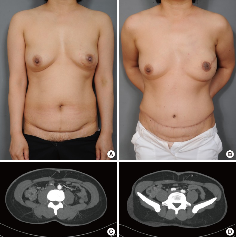 Donor site aesthetics and morbidity after DIEP flap breast